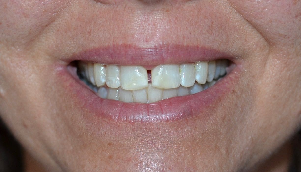 Before cosmetic dentistry procedure