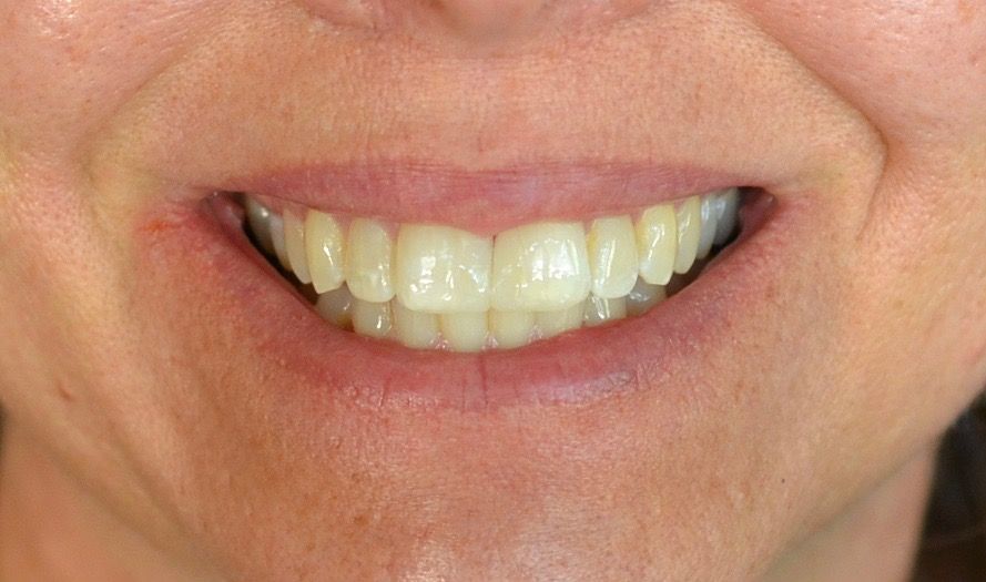 After cosmetic dentistry procedure