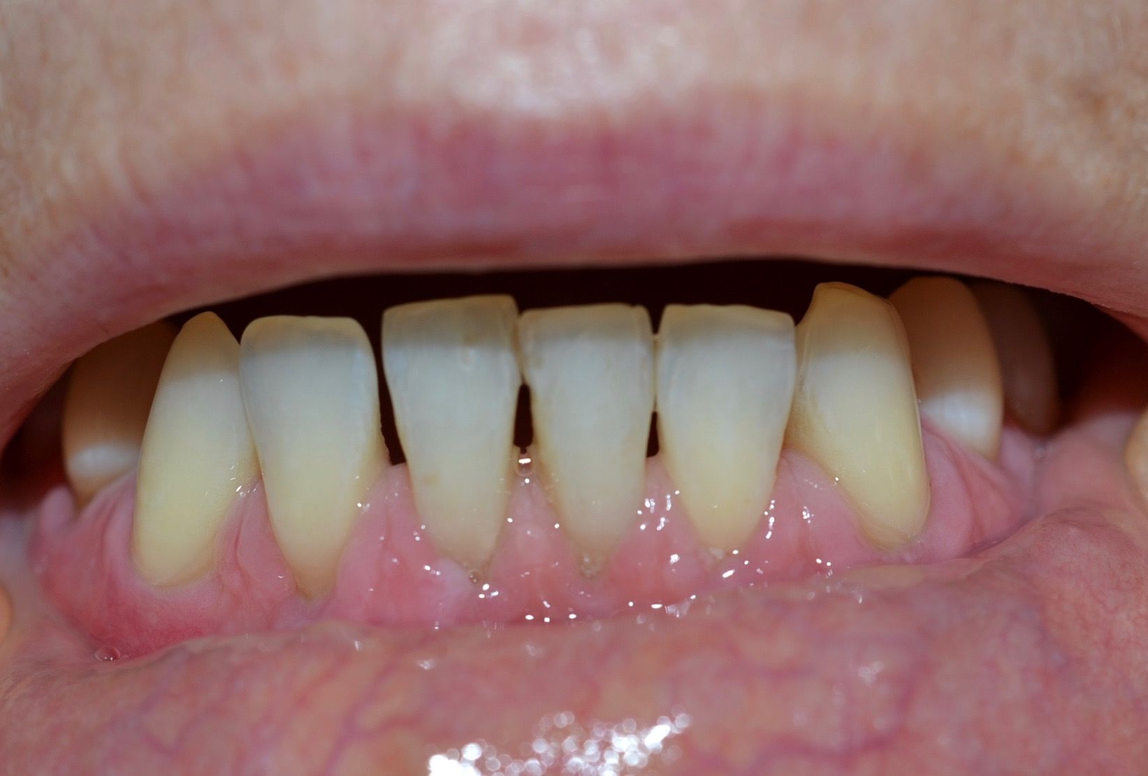 After dental treatments