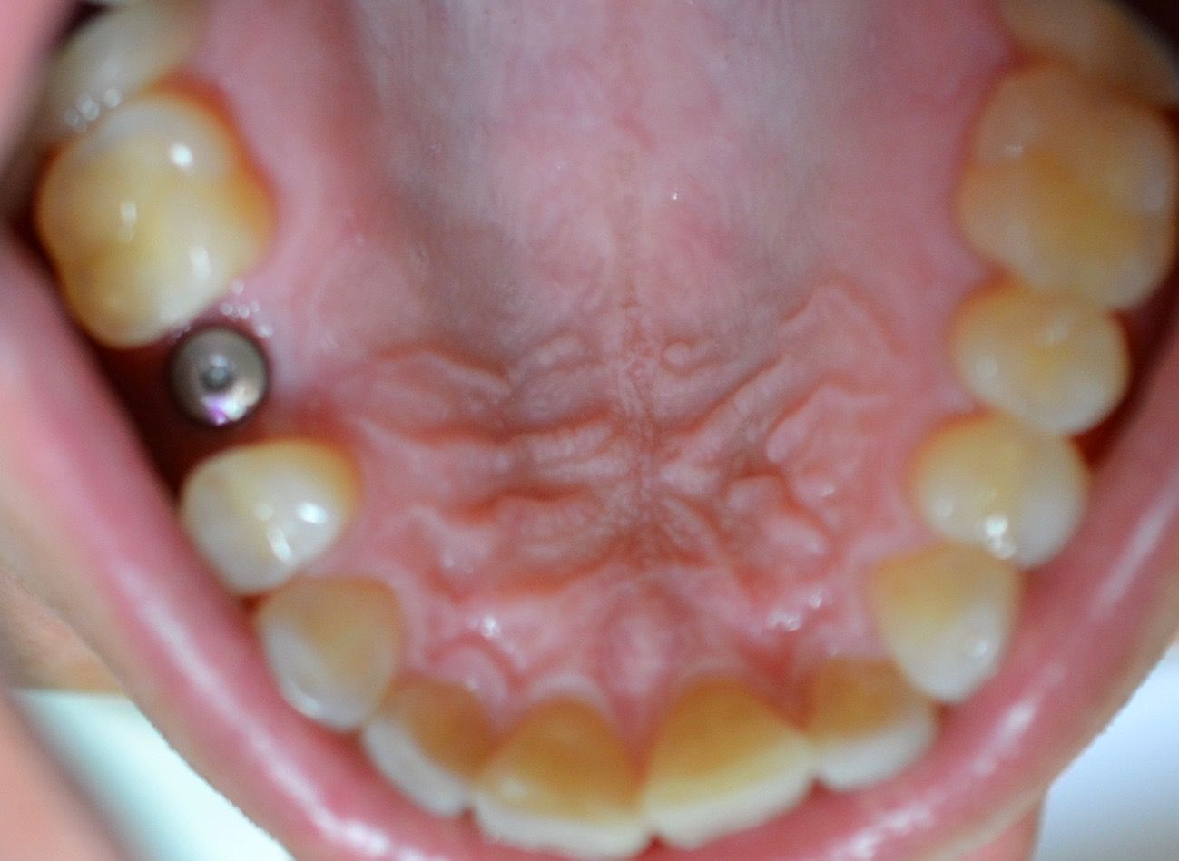 Before dental treatments