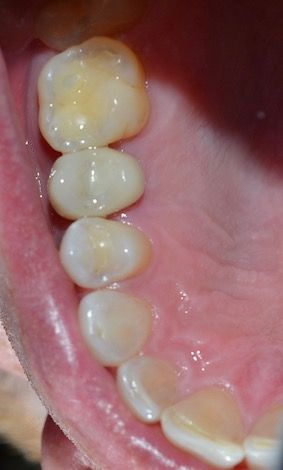 After dental treatments