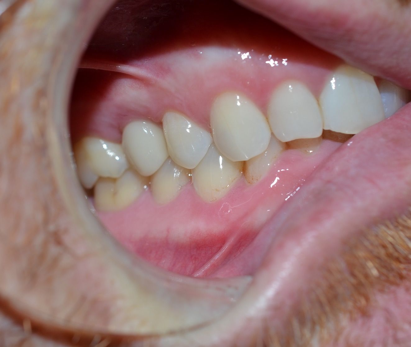 After Dental Implant Procedure